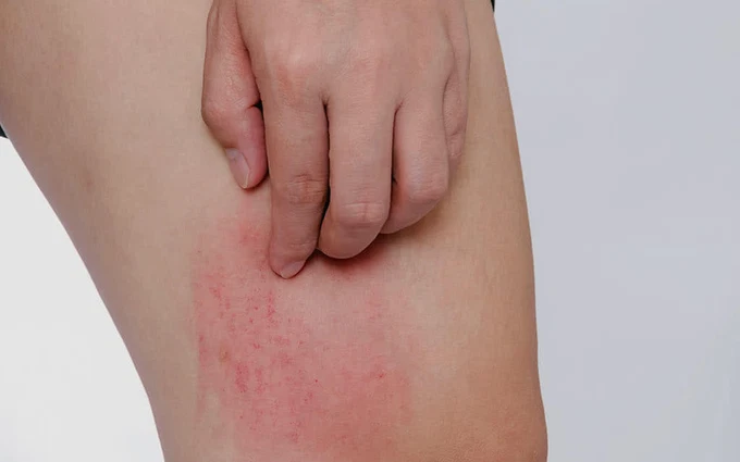 3 Bệnh nấm da thường gặp trong mùa hè và thuốc điều trị