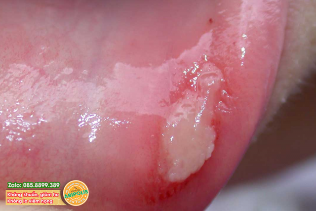 Bệnh Behcet cũng có thể gây nhiệt miệng nhưng vết loét thường to, loét rộng